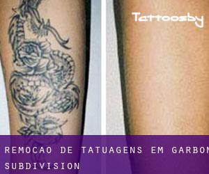 Remoção de tatuagens em Garbon Subdivision