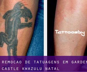 Remoção de tatuagens em Garden Castle (KwaZulu-Natal)