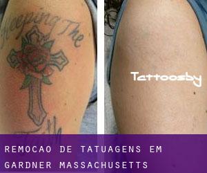 Remoção de tatuagens em Gardner (Massachusetts)
