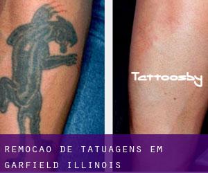 Remoção de tatuagens em Garfield (Illinois)