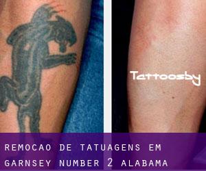 Remoção de tatuagens em Garnsey Number 2 (Alabama)