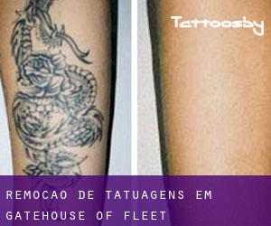 Remoção de tatuagens em Gatehouse of Fleet