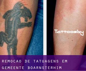 Remoção de tatuagens em Gemeente Boarnsterhim