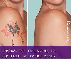 Remoção de tatuagens em Gemeente De Ronde Venen