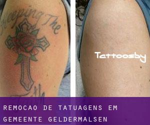 Remoção de tatuagens em Gemeente Geldermalsen