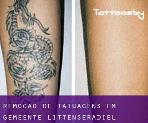 Remoção de tatuagens em Gemeente Littenseradiel