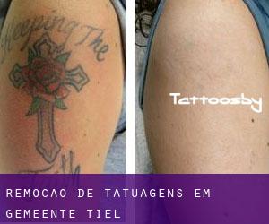 Remoção de tatuagens em Gemeente Tiel