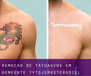 Remoção de tatuagens em Gemeente Tytsjerksteradiel