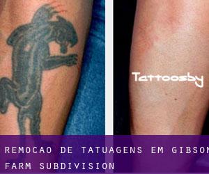 Remoção de tatuagens em Gibson Farm Subdivision