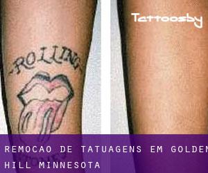 Remoção de tatuagens em Golden Hill (Minnesota)