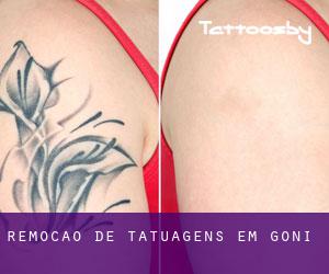 Remoção de tatuagens em Goñi