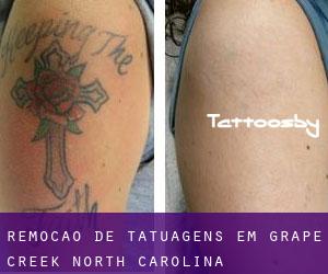 Remoção de tatuagens em Grape Creek (North Carolina)
