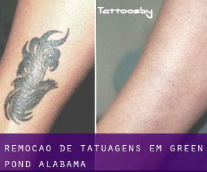 Remoção de tatuagens em Green Pond (Alabama)