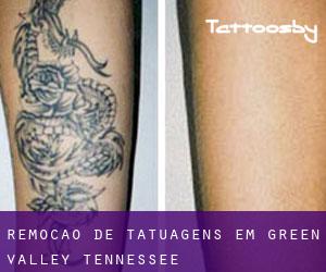 Remoção de tatuagens em Green Valley (Tennessee)