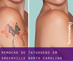 Remoção de tatuagens em Greenville (North Carolina)