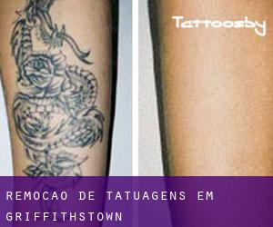 Remoção de tatuagens em Griffithstown