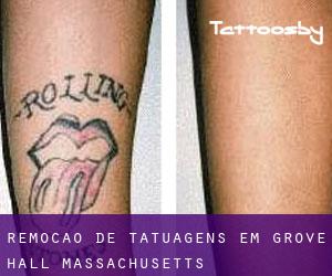 Remoção de tatuagens em Grove Hall (Massachusetts)