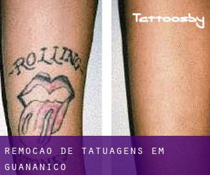 Remoção de tatuagens em Guananico