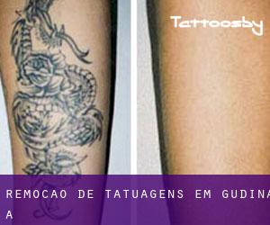Remoção de tatuagens em Gudiña (A)