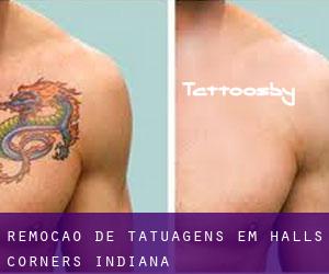 Remoção de tatuagens em Halls Corners (Indiana)