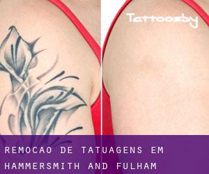 Remoção de tatuagens em Hammersmith and Fulham