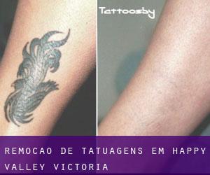 Remoção de tatuagens em Happy Valley (Victoria)