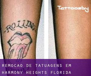 Remoção de tatuagens em Harmony Heights (Florida)