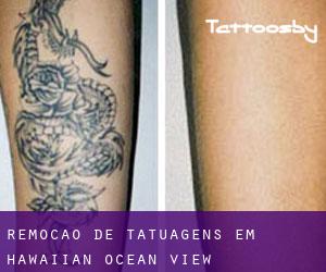 Remoção de tatuagens em Hawaiian Ocean View