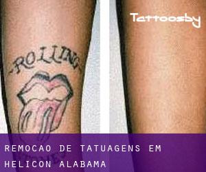 Remoção de tatuagens em Helicon (Alabama)
