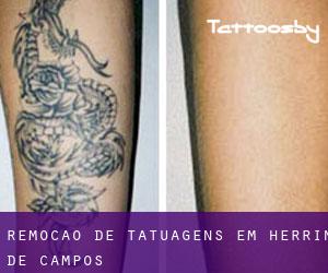Remoção de tatuagens em Herrín de Campos
