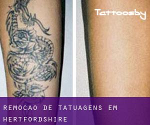 Remoção de tatuagens em Hertfordshire