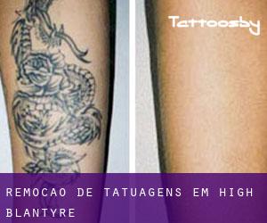 Remoção de tatuagens em High Blantyre