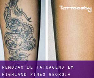 Remoção de tatuagens em Highland Pines (Georgia)