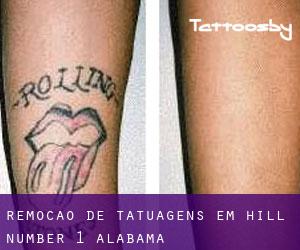 Remoção de tatuagens em Hill Number 1 (Alabama)