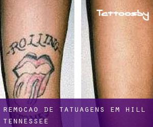 Remoção de tatuagens em Hill (Tennessee)