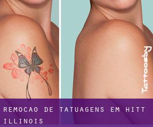 Remoção de tatuagens em Hitt (Illinois)