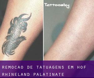 Remoção de tatuagens em Hof (Rhineland-Palatinate)