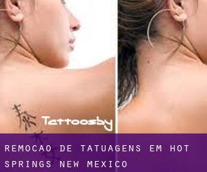 Remoção de tatuagens em Hot Springs (New Mexico)