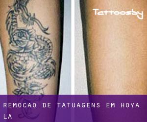 Remoção de tatuagens em Hoya (La)