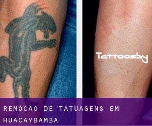 Remoção de tatuagens em Huacaybamba