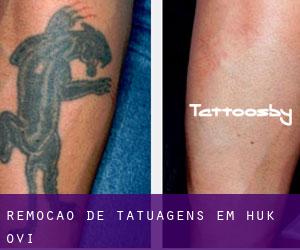 Remoção de tatuagens em Huk Ovi