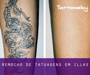 Remoção de tatuagens em Illas