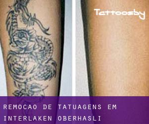 Remoção de tatuagens em Interlaken-Oberhasli