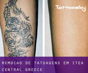 Remoção de tatuagens em Itéa (Central Greece)