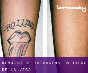 Remoção de tatuagens em Itero de la Vega