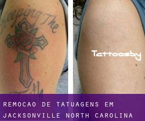 Remoção de tatuagens em Jacksonville (North Carolina)