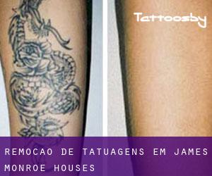 Remoção de tatuagens em James Monroe Houses