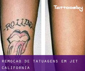 Remoção de tatuagens em Jet (California)