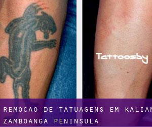 Remoção de tatuagens em Kalian (Zamboanga Peninsula)