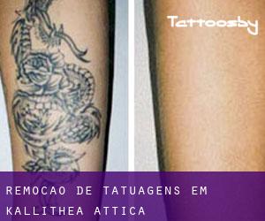 Remoção de tatuagens em Kallithea (Attica)